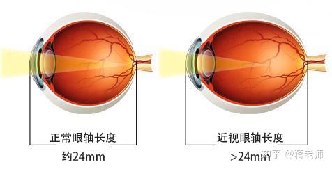 為500度)或眼軸長度在26mm以上叫高度近視,那麼高度近視有什麼危害呢