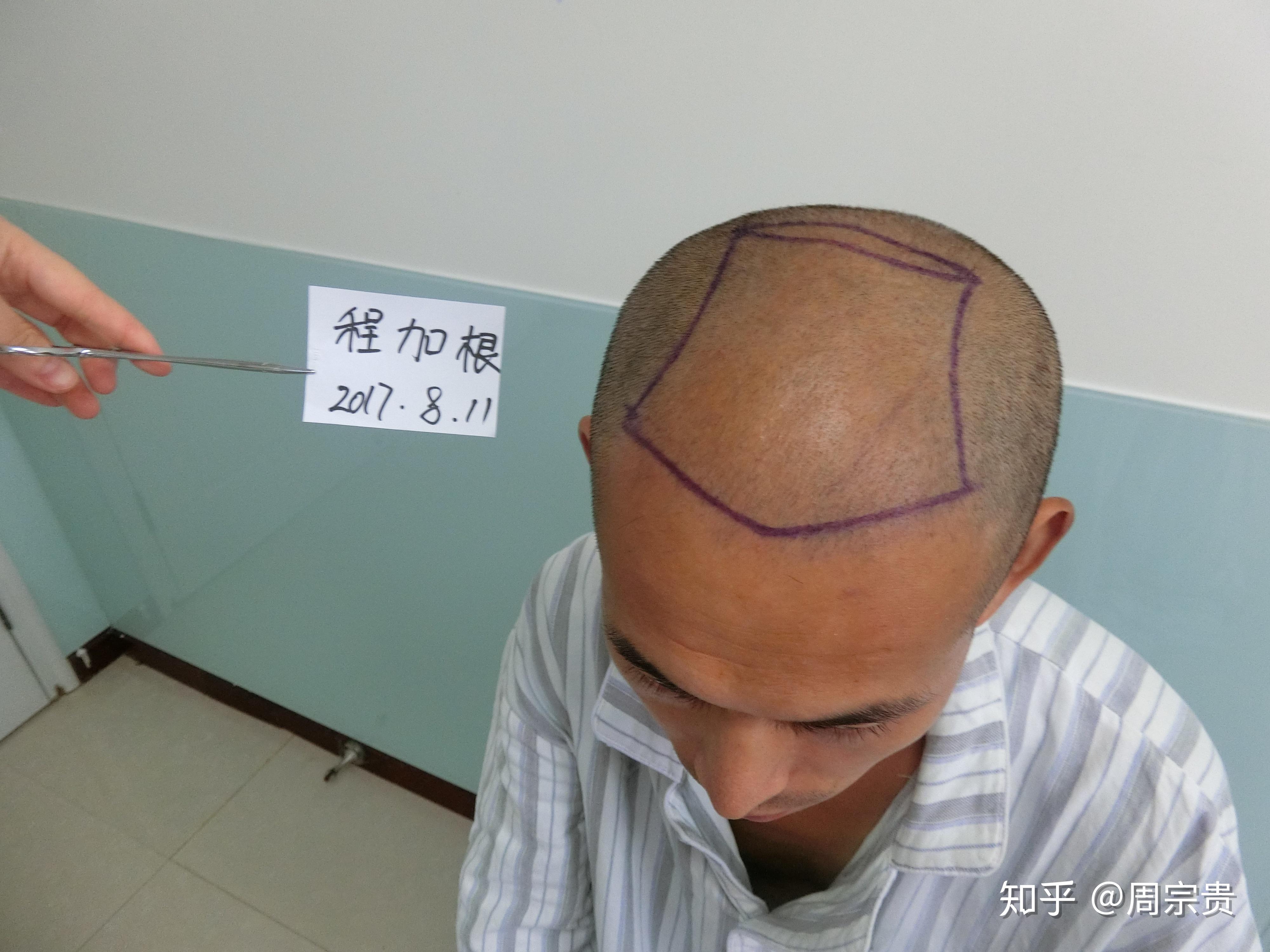 5级脱发植发3000单位前后的变化究竟有多大