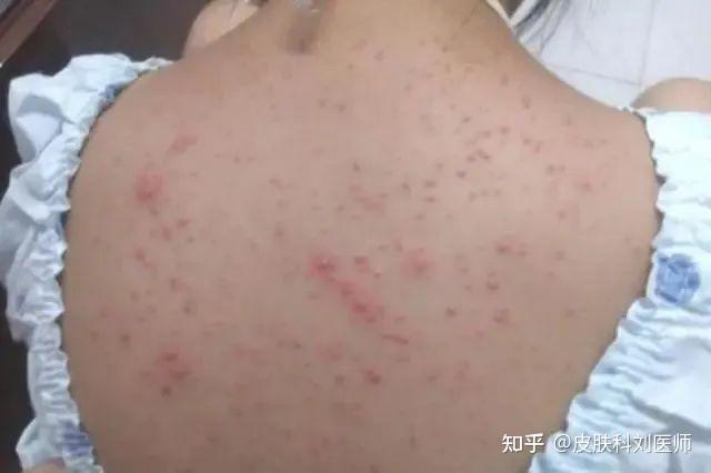 什么原因会引起毛囊炎?避开这4个,皮肤炎症少一点 - 知乎