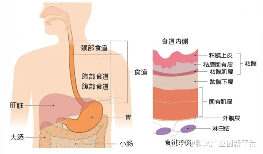 非血管支架1——食管恶性疾病治疗方向?食管支架产品解读 - 知乎