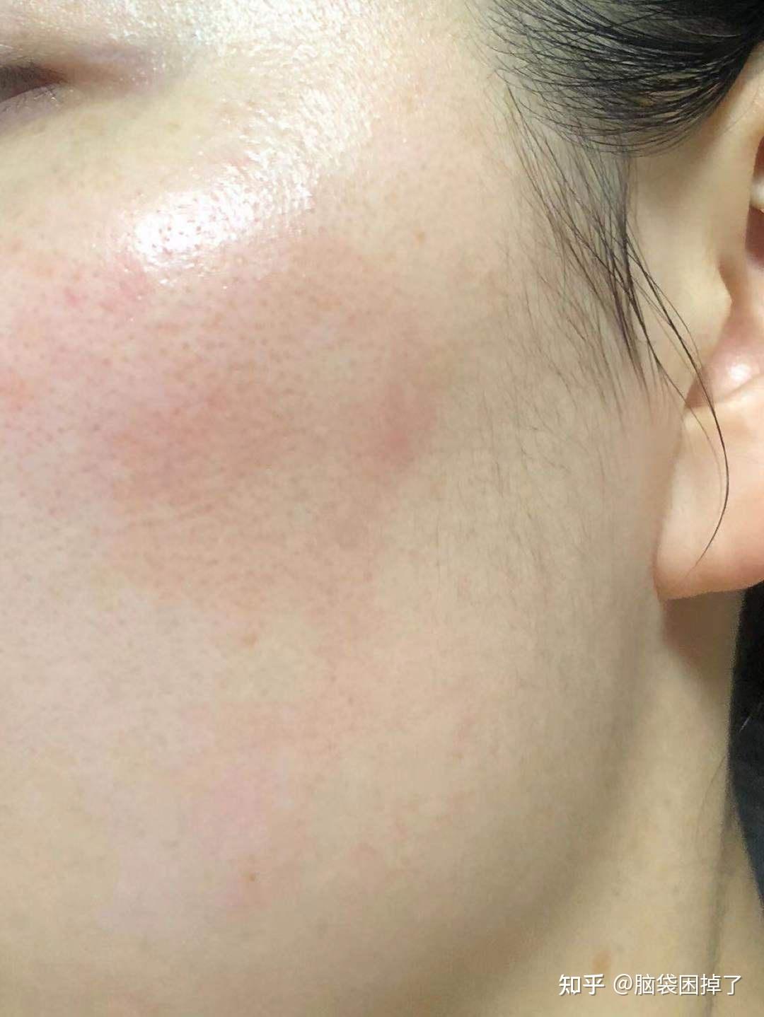 敏感泛红肌肤怎么来的有哪些修复红血丝的干货护肤品推荐