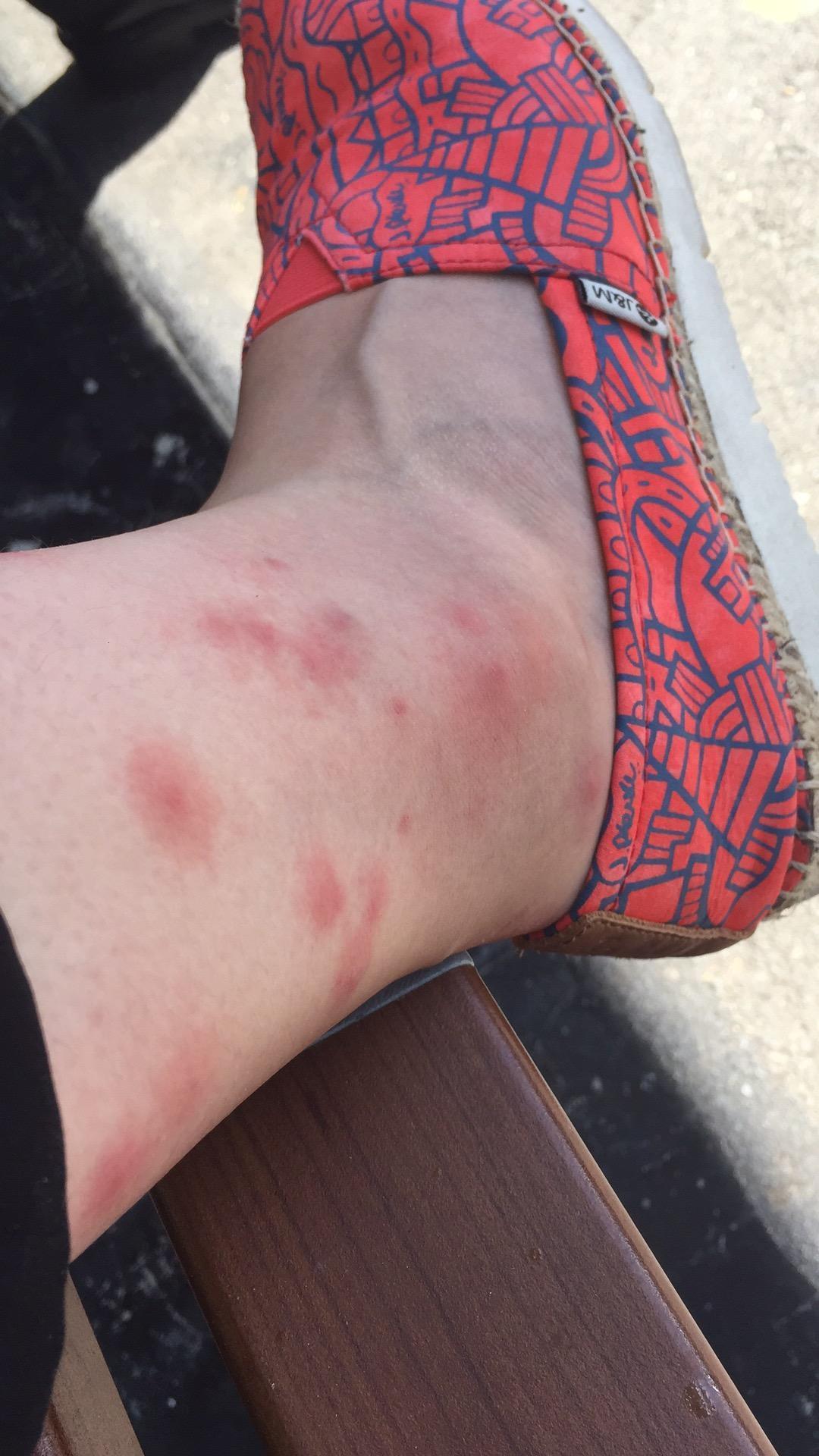 被bedbugs咬的经历