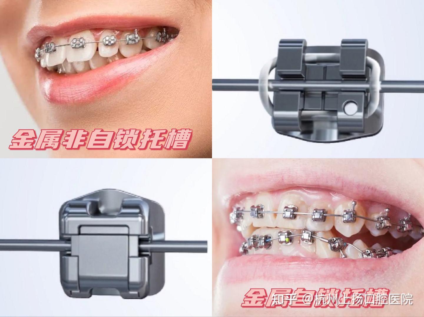 牙套内侧固定器图片