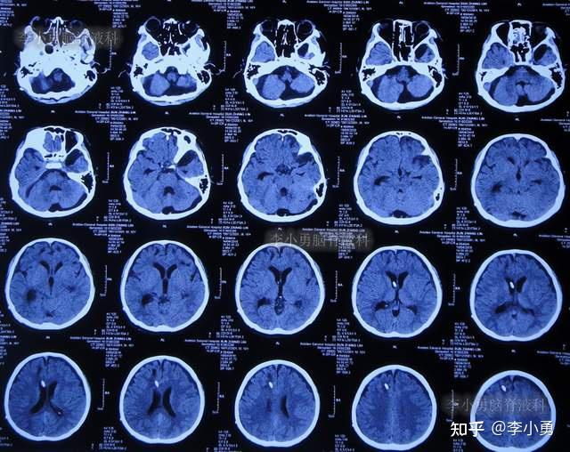 车祸脑和全身多处重伤深昏迷,内镜三室造瘘术 脑室引流术失败仍脑积水