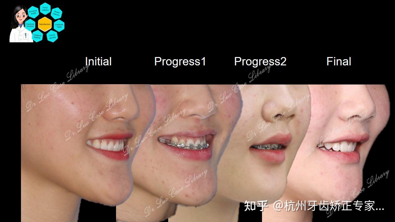 偏颌大下巴正畸正颌联合治疗 - 知乎
