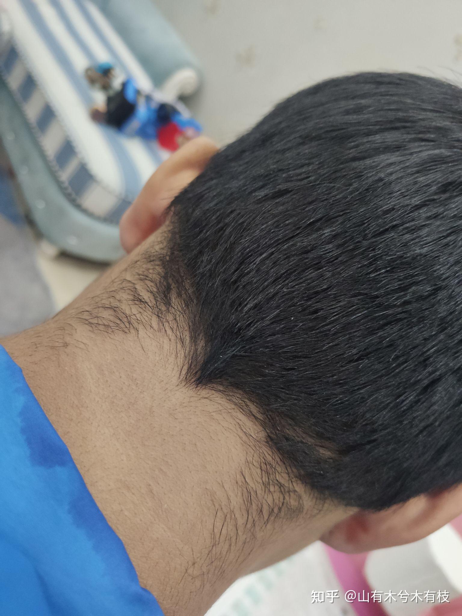 头发都长到脖子上去了扎起来太难看了有什么办法去掉这些头发吗