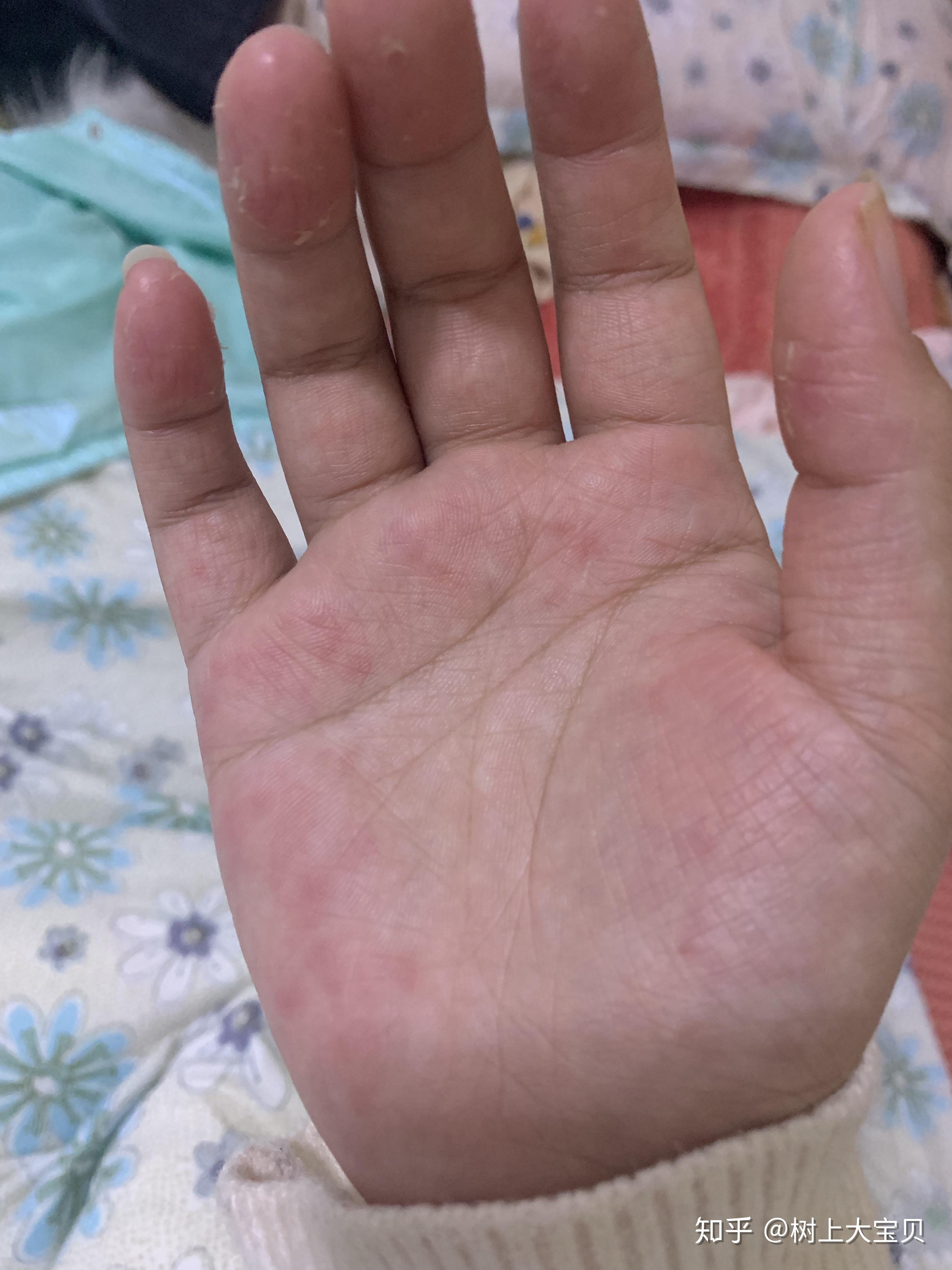 有对洗衣粉洗衣液过敏的人吗