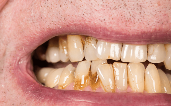 尼古丁和二氧化碳,从而很快的导致我们的牙齿变黄发黑,吸烟5年,就会