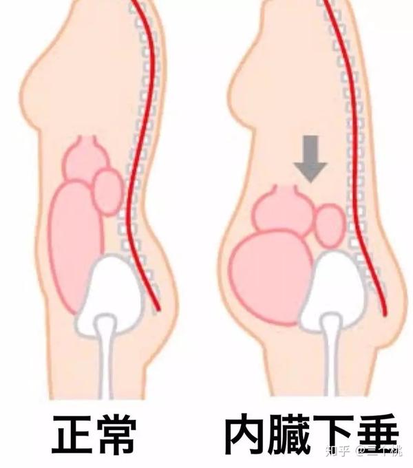 除了往外凸,它還往下壓,壓迫內臟器官往下移,最後移到小腹那裡不讀慫