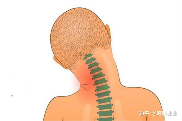 痉挛性斜颈相关治疗方法 - 知乎