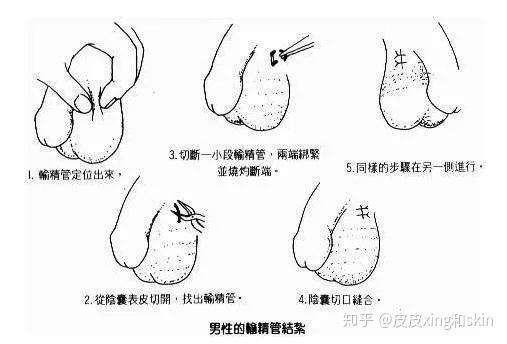 男人结扎好还是女生结扎好我算了一笔账