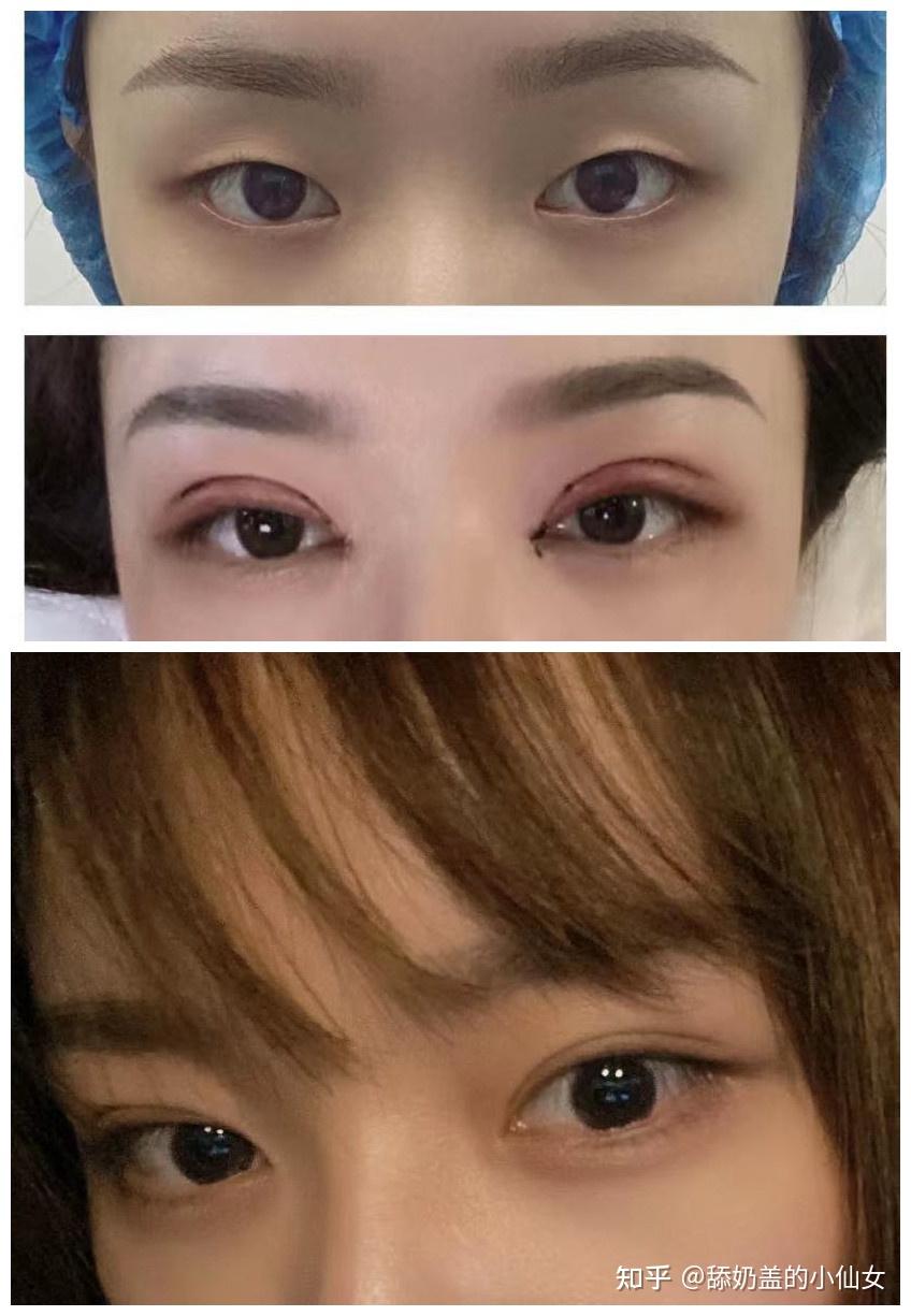 吊眼割什么形状的双眼皮比较好?