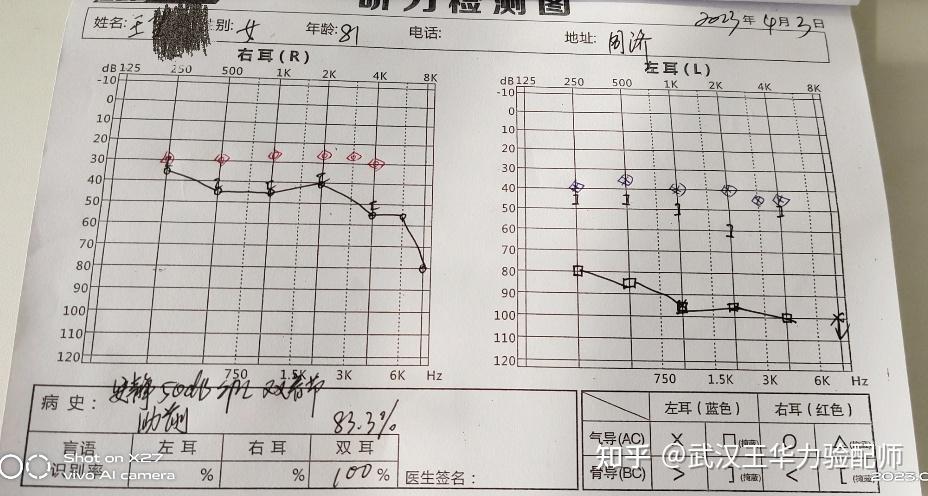 双耳非对称性听力损失的助听器验配 - 知乎