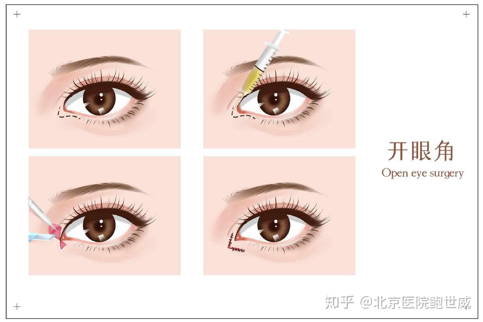 关于开眼角的五大认识误区你知道吗