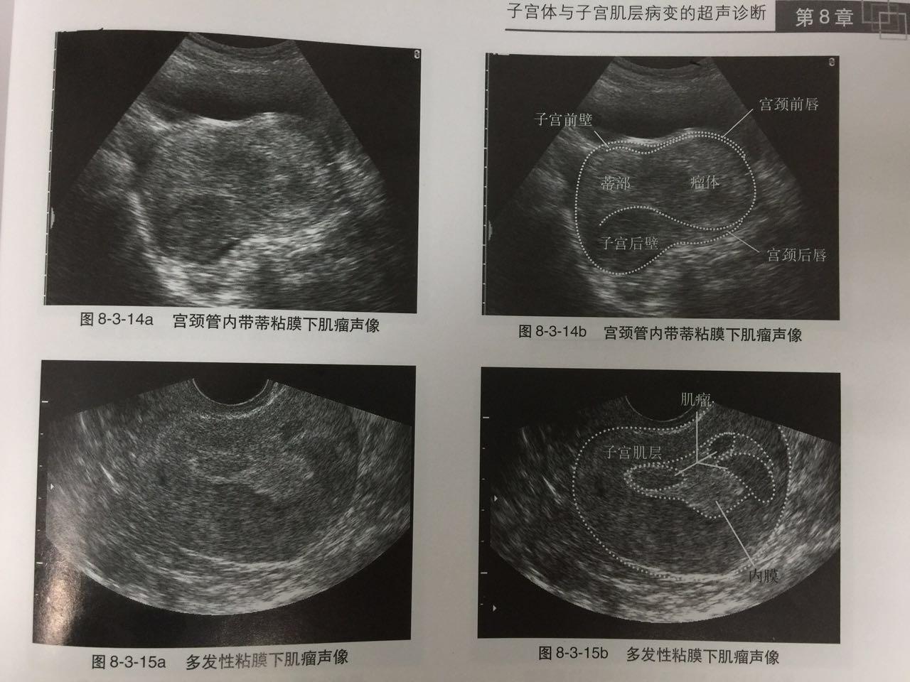 子宫肉瘤彩超图片图片