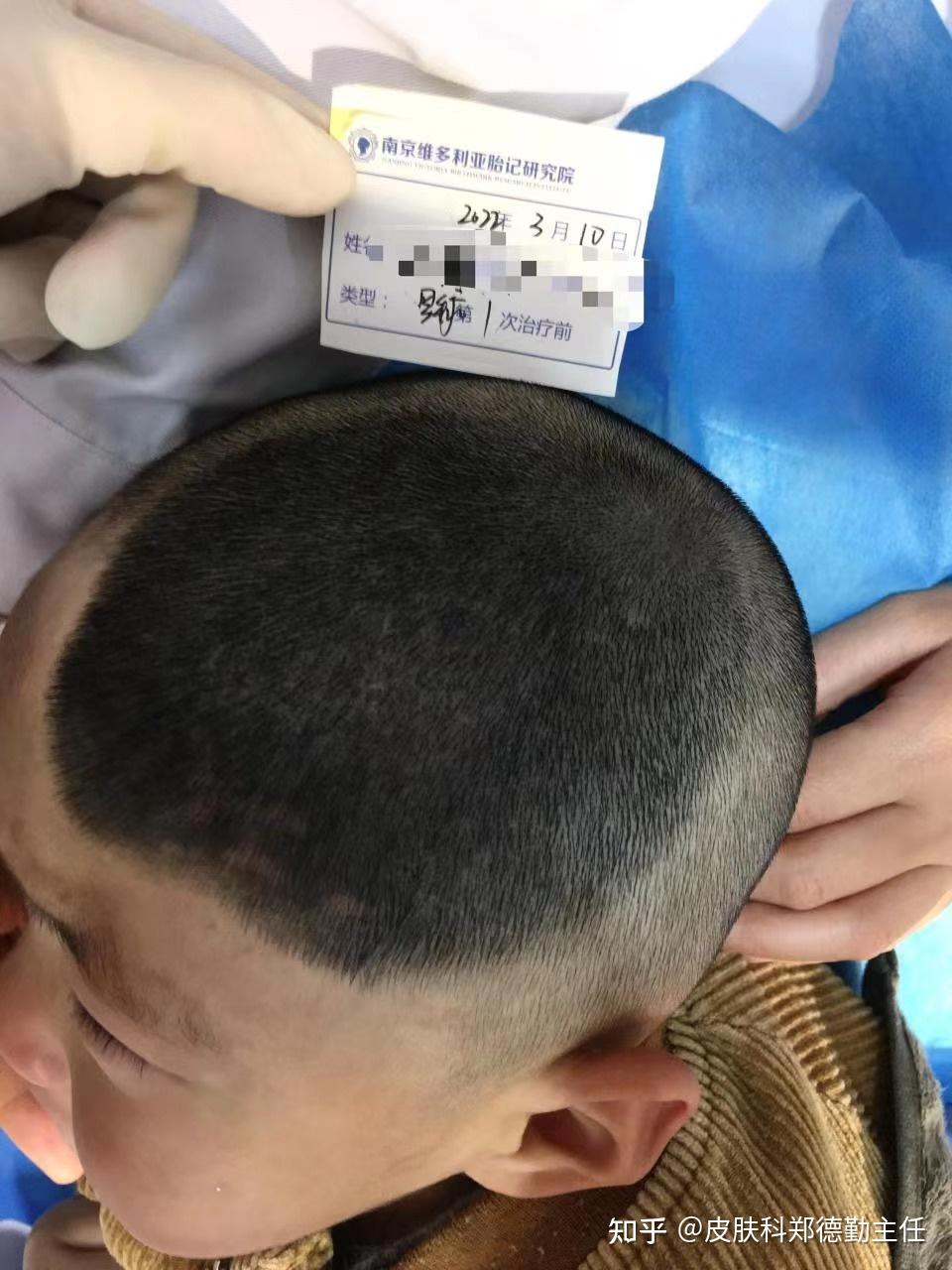 "胎记跟宝宝一起长大,急坏父母!