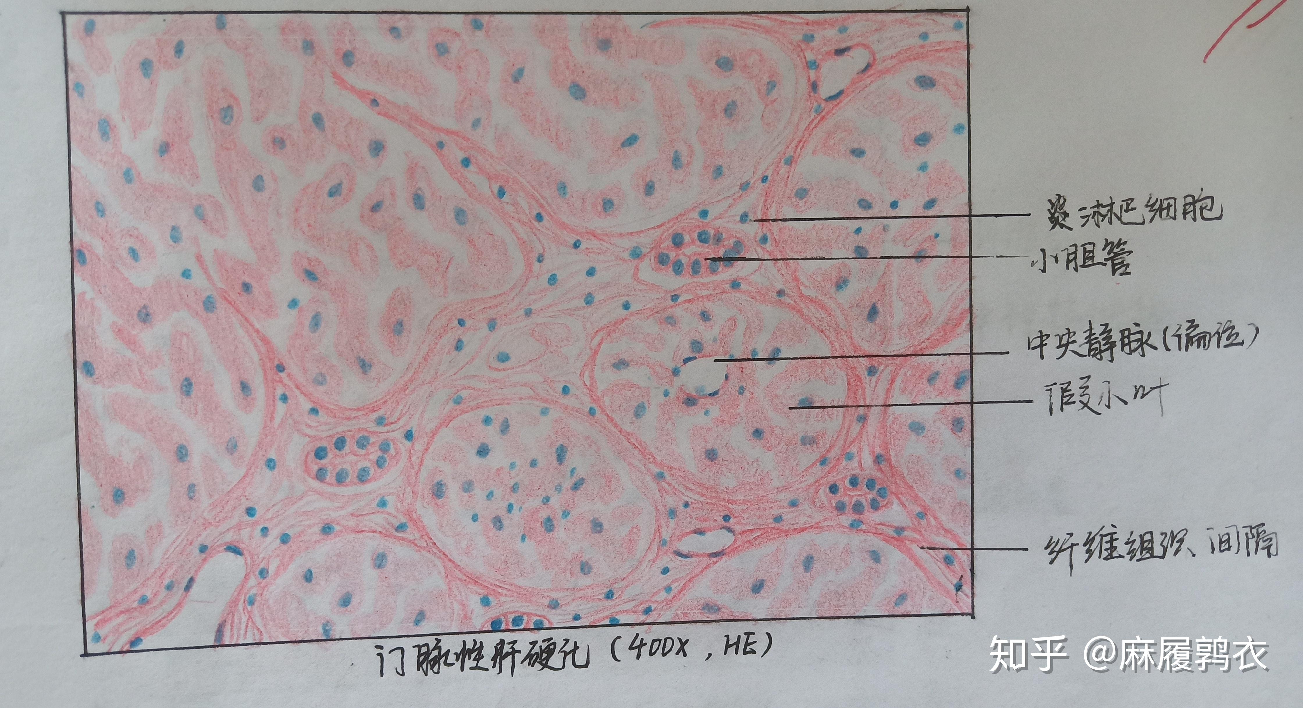 为什么咱们不弄个病理红蓝手绘图的问题呢? - 知乎