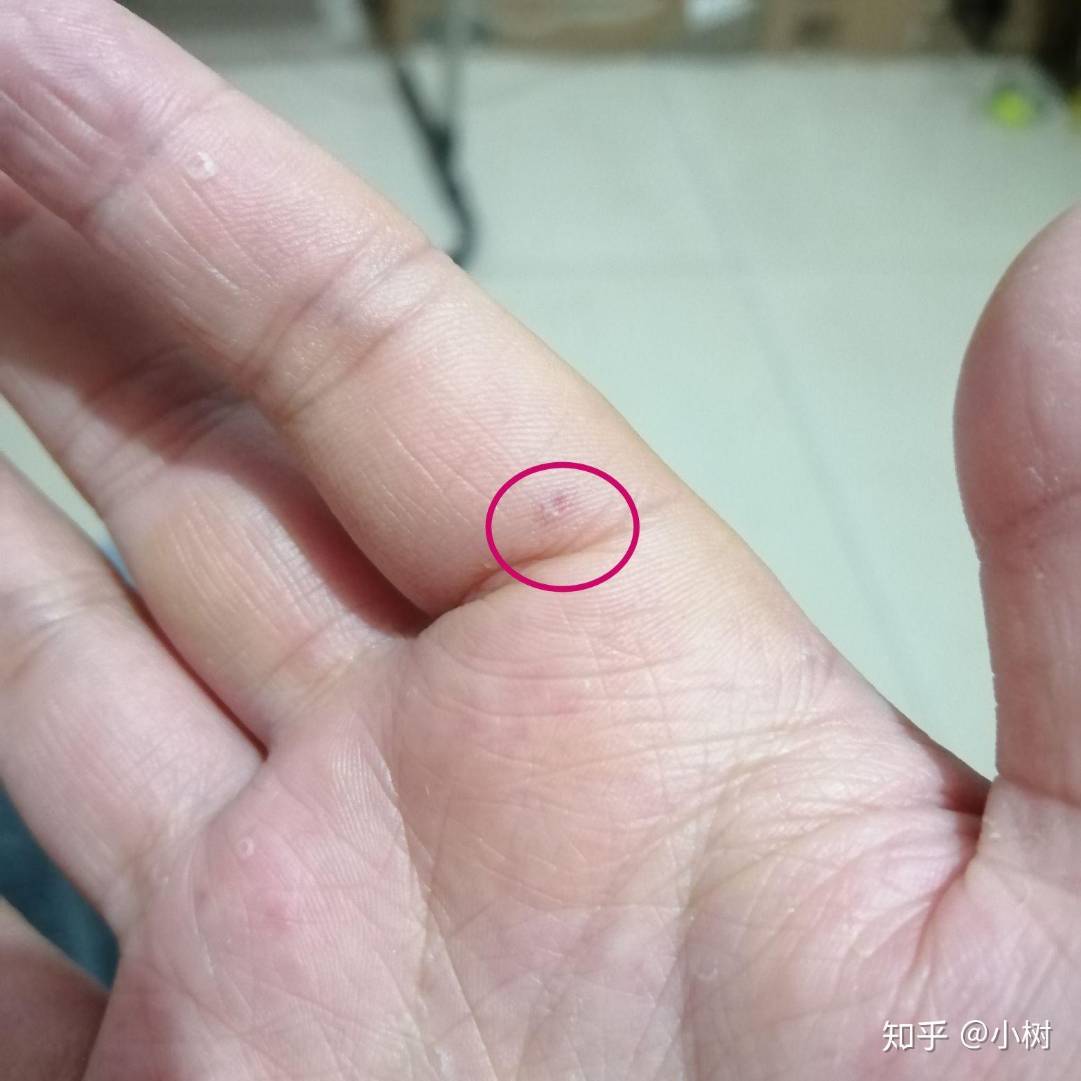 昨天晚上被流浪猫抓伤,伤口很小几乎看不见,但是渗出一点血,需不需打