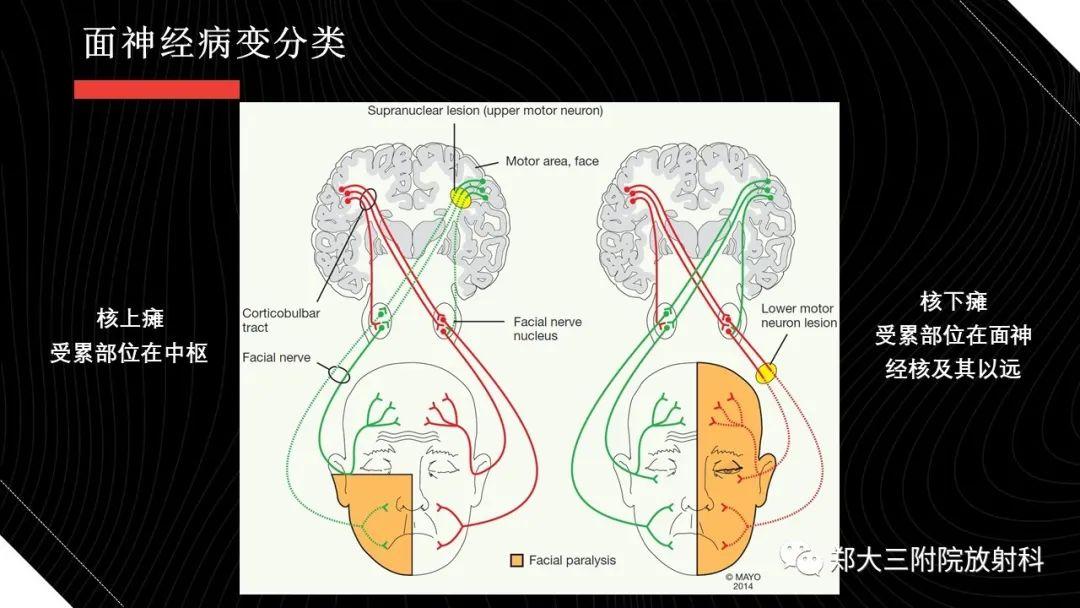 面神经常见疾病的影像表现 - 知乎