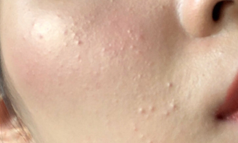 怎么才能不长白头粉刺 v2-35ba78548becfa639a8e582f633d0eef_r.jpg