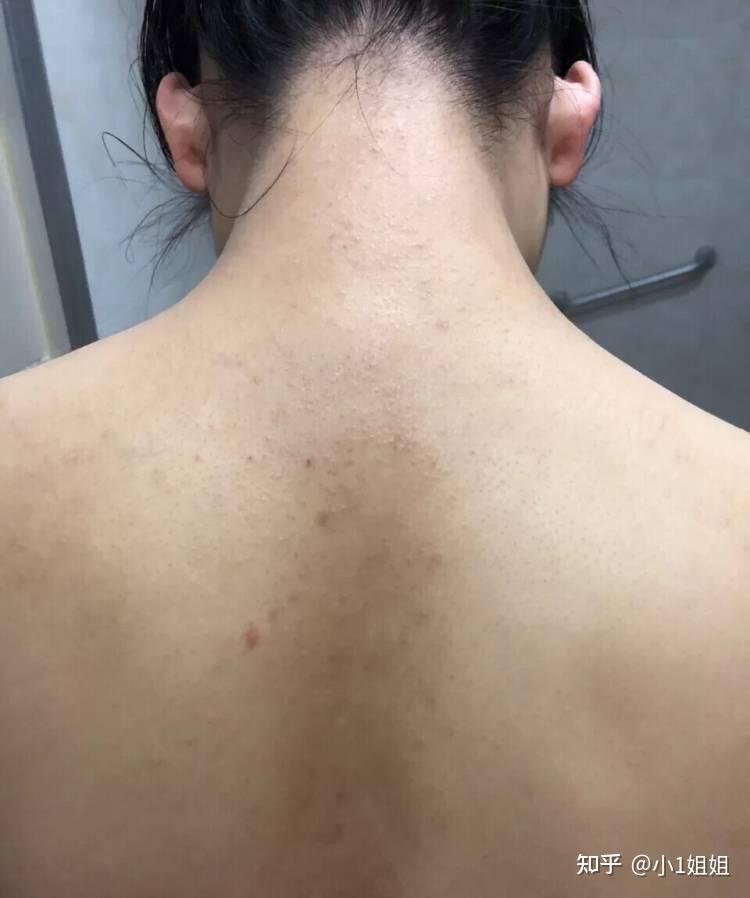 背后容易长痘还总爱出油用hosono苦参咖啡磨砂膏可以缓解吗效果怎么样