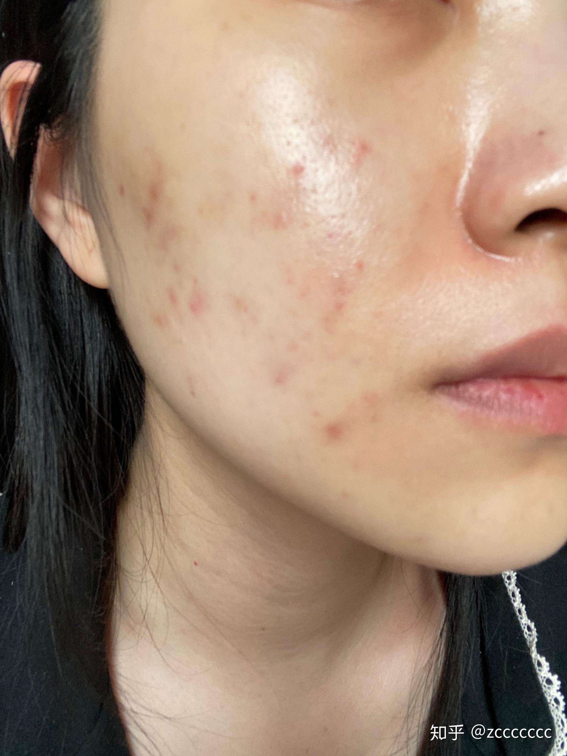 维a酸乳膏使用日记