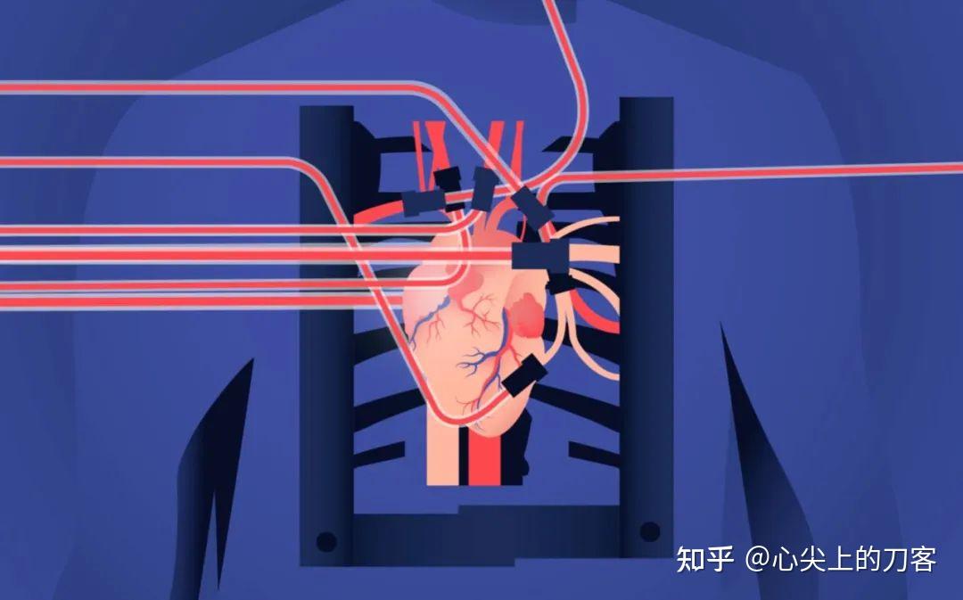 心脏移植是如何运行的