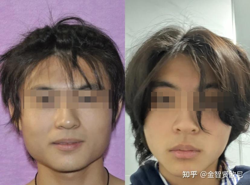 男生发腮如何用医美手段高效解决? - 知乎