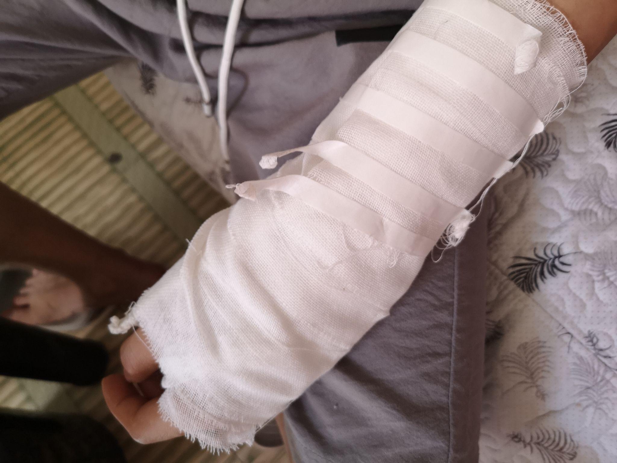 好朋友胳膊骨折了该怎么去嘲笑他