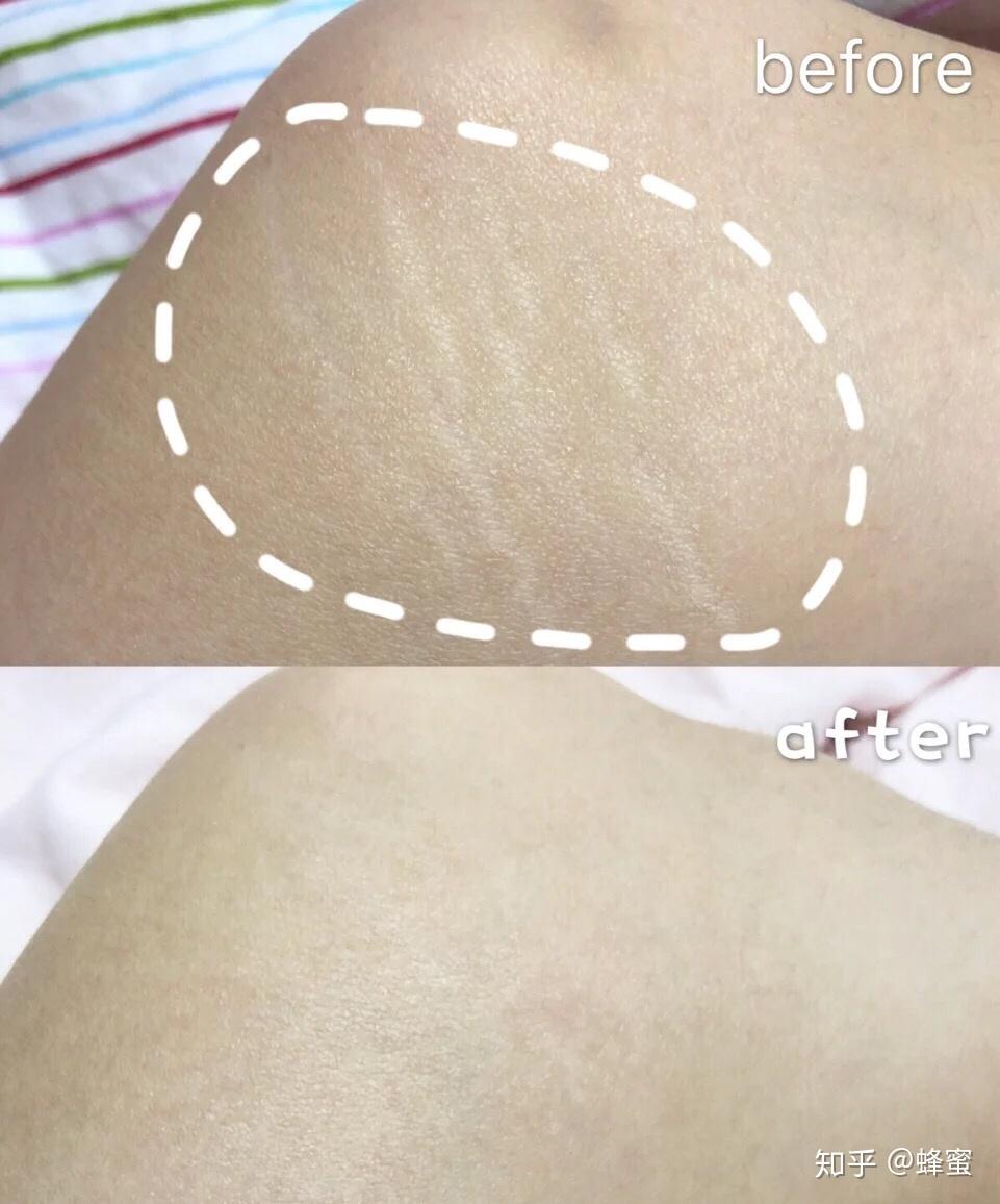 生长纹肥胖纹白色的有点波浪线的有淡化成功的么