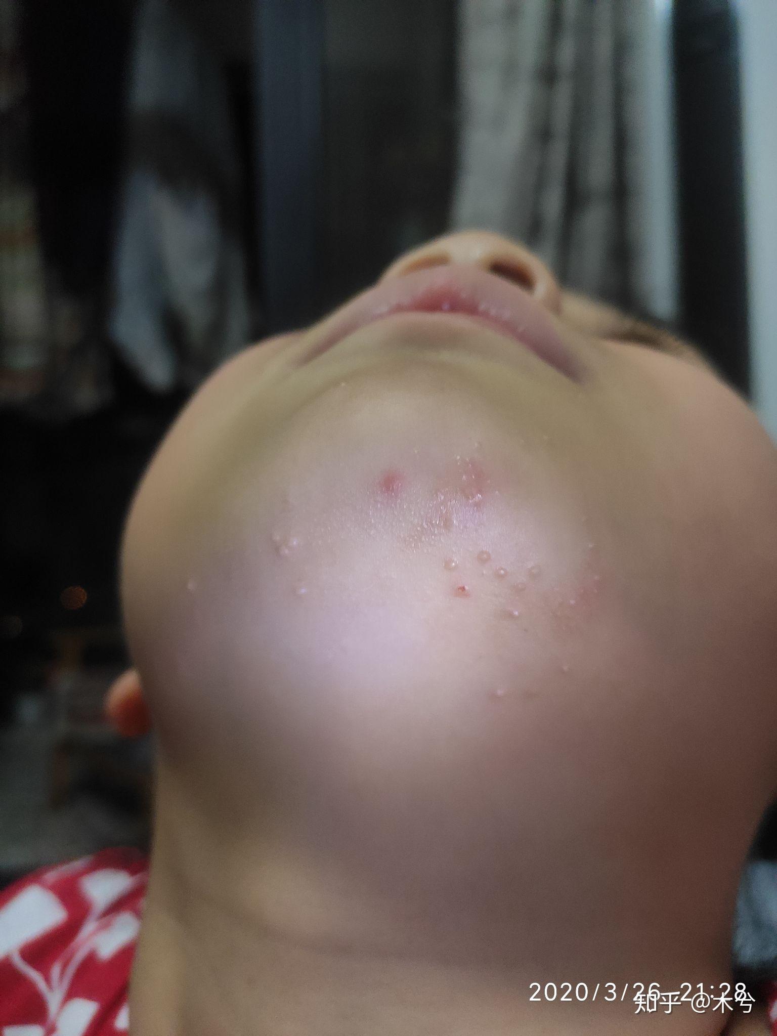 儿童下巴长传染性软疣,治疗全过程(图片涉及自家宝宝,请勿他用,谢谢)
