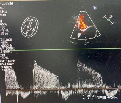 经过充分的术前准备及影像学评估,张申伟教授带领心内科介入团队梁