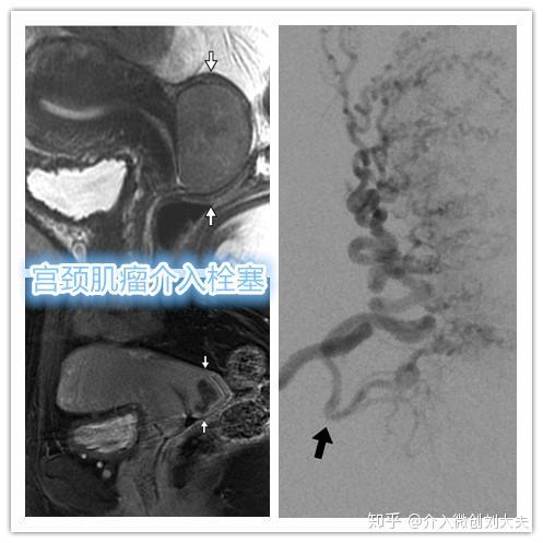 子宫肌瘤与介入栓塞的那些事 知乎