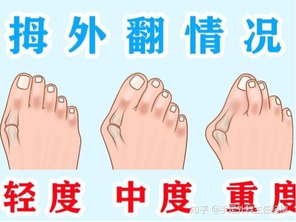拇外翻纪柳：分享拇外翻治疗细节 - 知乎