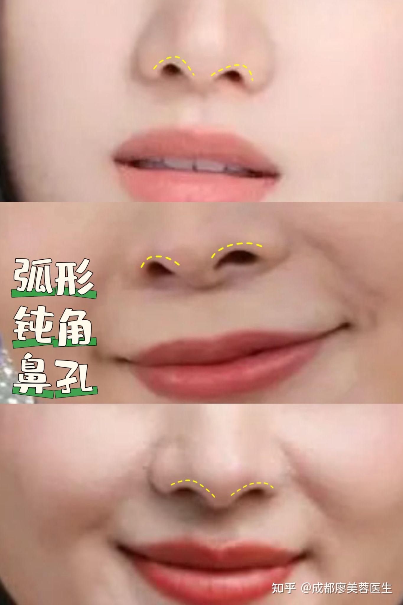 当你的鼻孔呈现三角形锐角状态,请注意! - 知乎