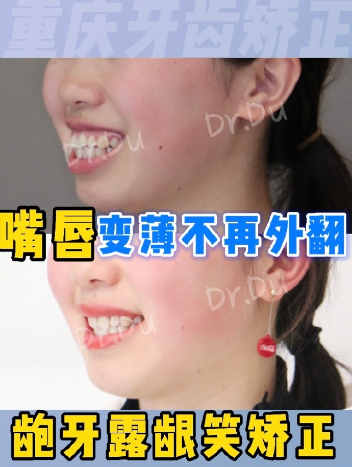 重庆牙齿矫正丨正畸2年时间解决龅牙露龈笑