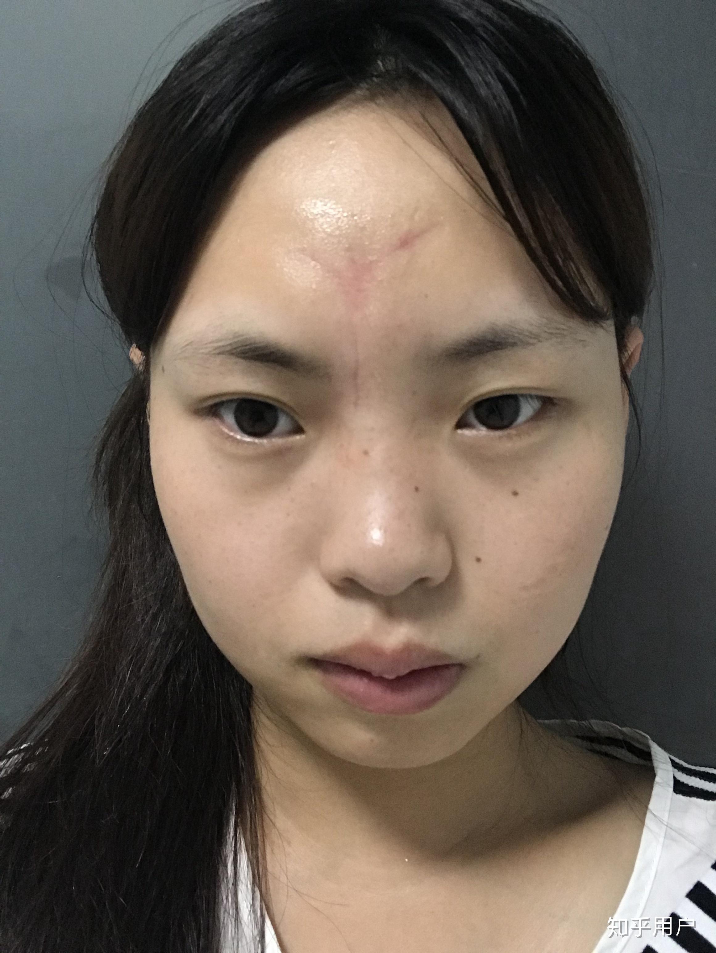 女生脸上有疤是怎样的体验