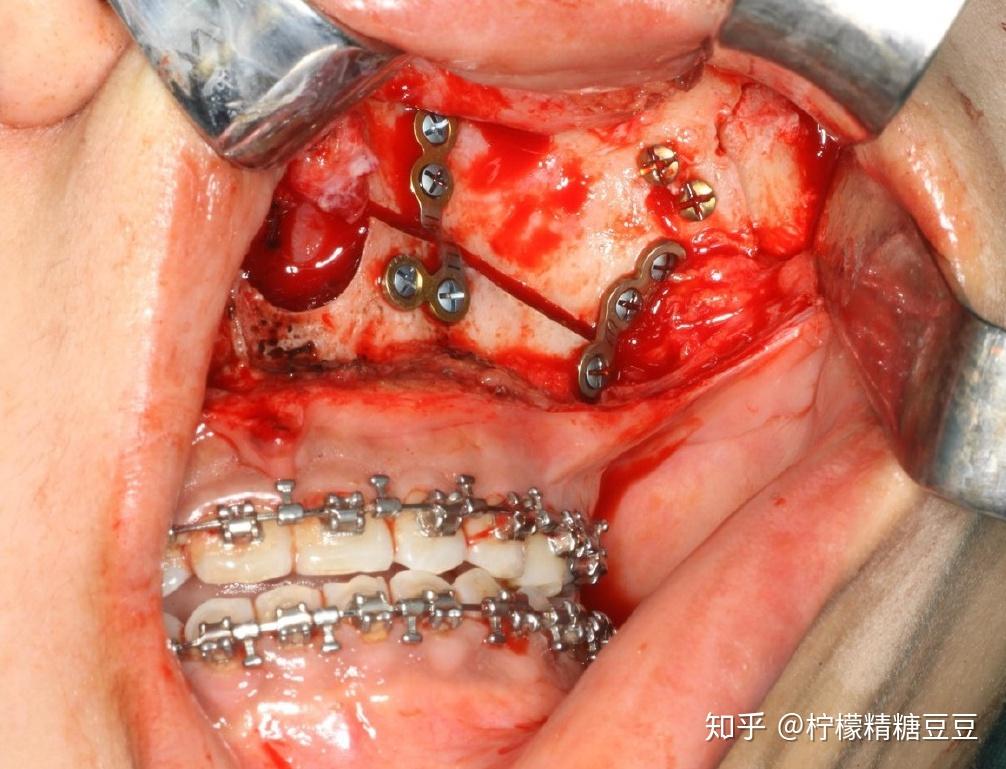 做完正颌手术有后悔吗后遗症有哪些