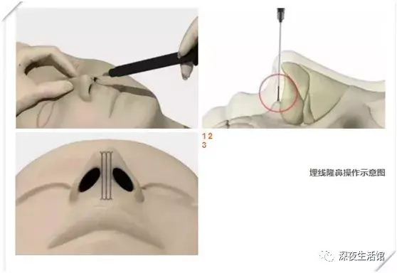 线雕隆鼻是怎么个原理 有什么危害吗 知乎