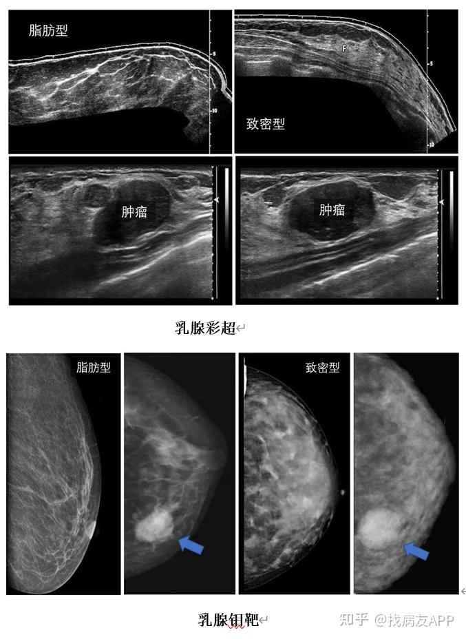 乳腺腺体致密图片