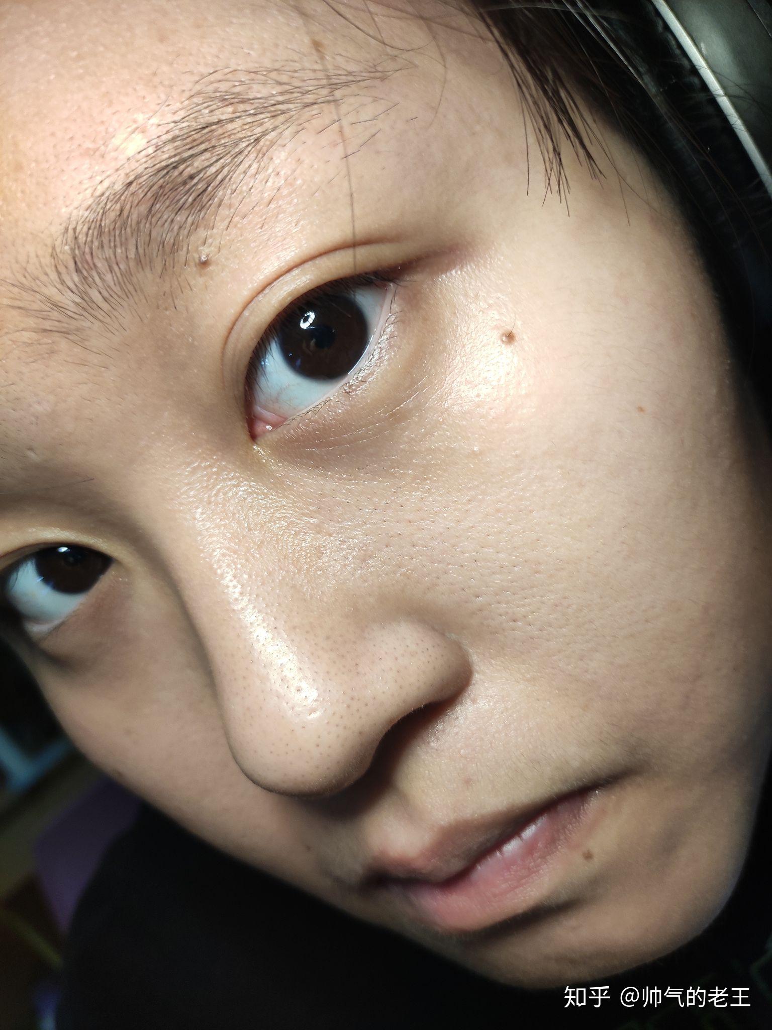 我这个是冰锥型痘坑嘛皮肤是毛孔粗大还是怎么了怎么办