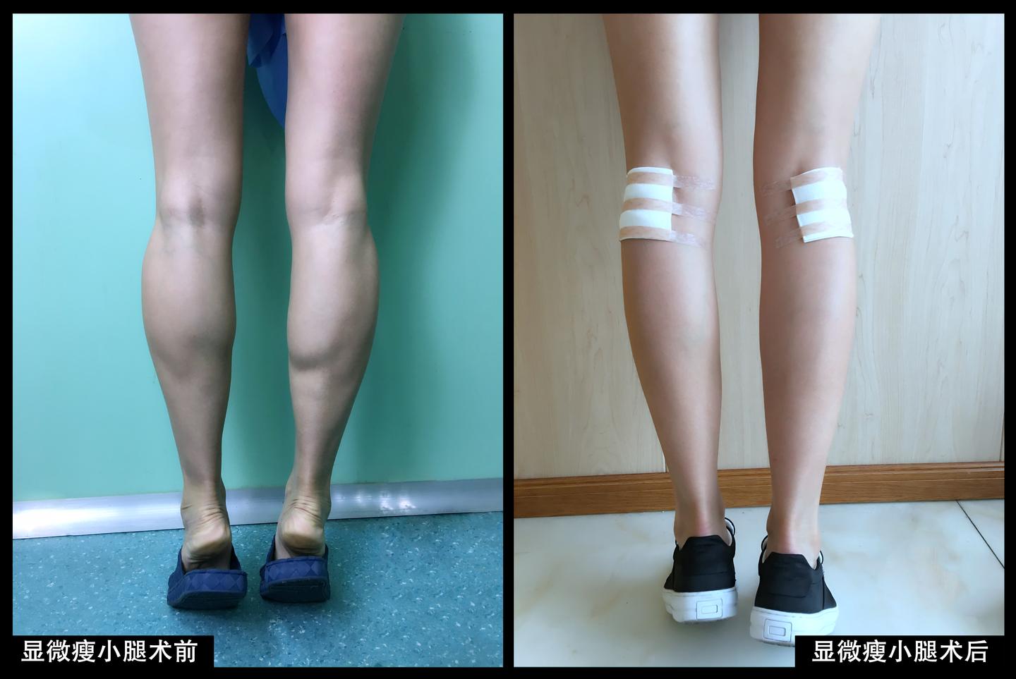 怎么才能瘦腿小腿 v2-3655371957247517791b33e48f3793a6_1440w.jpg?source=172ae18b