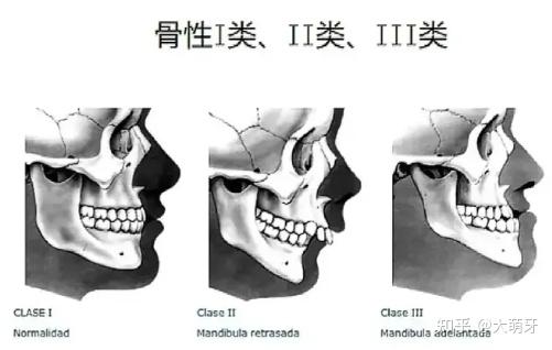 【正颌手术劝退篇】正颌手术有什么风险?术后能否达到标准面型?有哪些后遗症?如何选择正规靠谱正颌医院医生? - 知乎