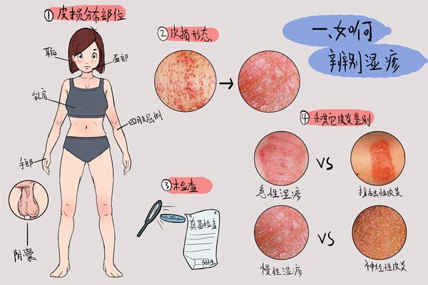 乳頭乳暈發紅還起皰可能是乳房溼疹5種方法教你保護乳房