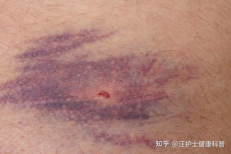 抽血后抽血处淤青得很严重