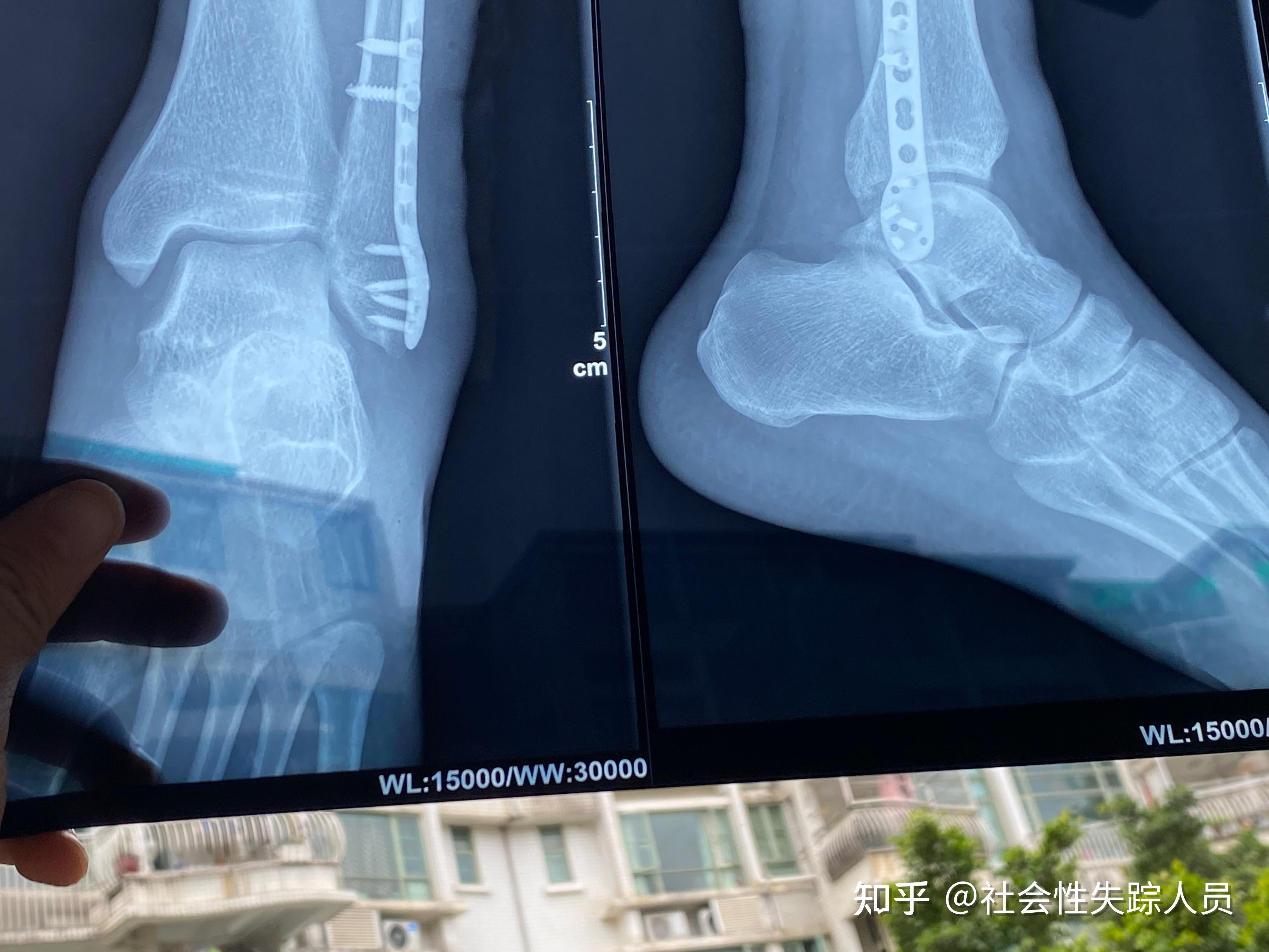 踝关节骨折日记手术