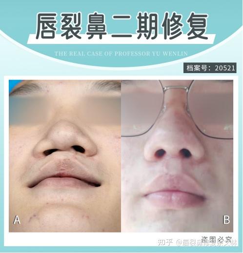 兔唇是罪吗?每次脱下口罩都被人嘲笑,怎么才能变得像正常人一样? - 知乎