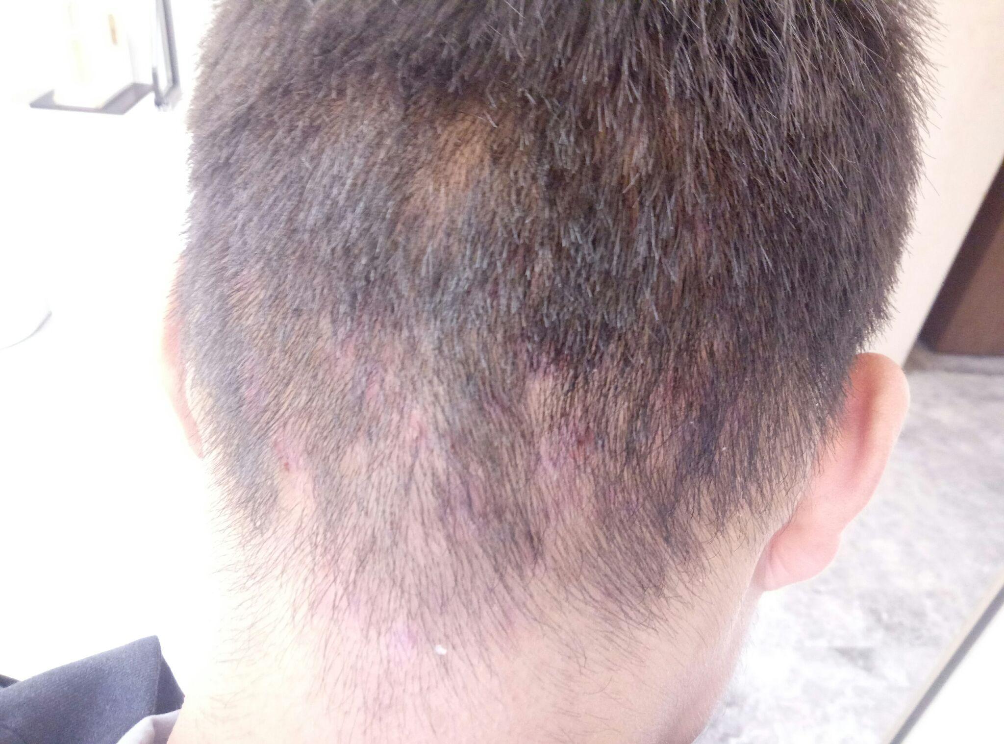 毛囊炎原来肿的地方掉了一块儿头发还能长出来吗