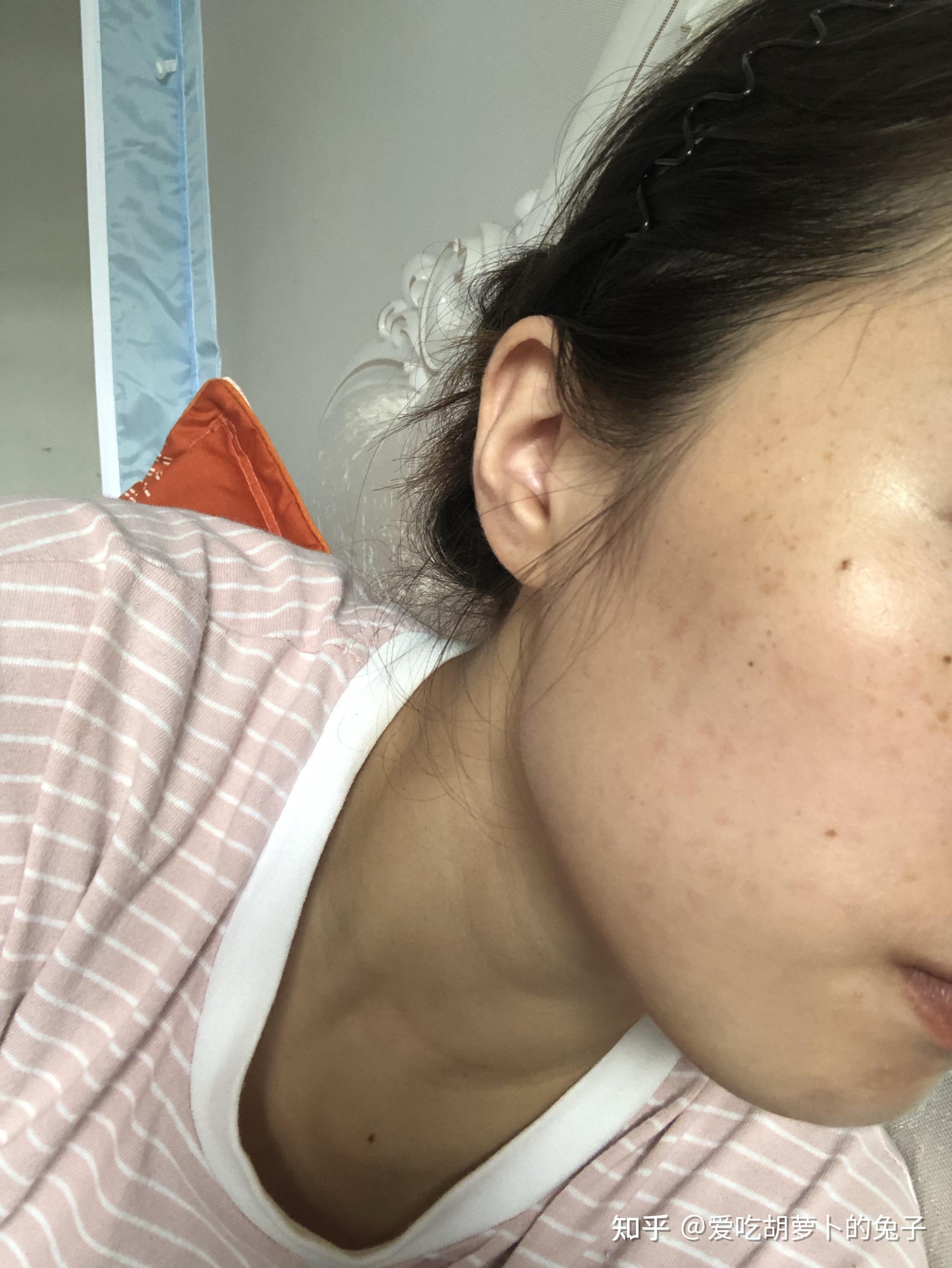 水光针术后长斑