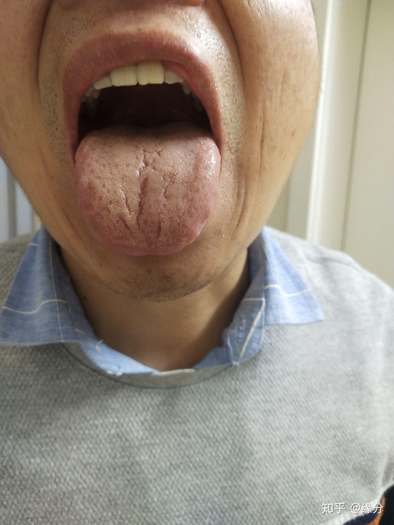 舌苔黄腻是什么病症? 